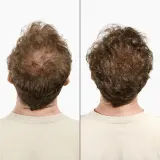 Klorane Quinine Anti-Hair Loss Shampoo - Укрепляющий шампунь против выпадения волос — фото 7