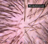 L’Oreal Professionnel Serie Expert Scalp Advanced - Уход за волосами и кожей головы, 200 мл — фото 3