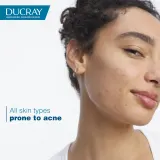 Ducray Keracnyl Foaming gel - Пенящийся гель для умывания жирной кожи с проблемами акне — фото 2