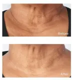 Perricone MD Cold Plasma Plus+ Sub-D/Neck - Укрепляющий крем для шеи и декольте, 59 мл — фото 5