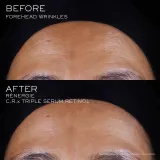 Lancome Renergie CRX Triple Serum Retinol - Сыворотка для лица — фото 5