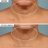 StriVectin Tighten & Lift TL Advanced Tightening Neck Cream Plus - Лифтинг-крем для укрепления кожи на шее и декольте — фото 4
