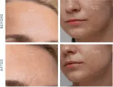 FOREO KIWI Derma - Устройство для диамантовой микродермабразии и глубокой очистки лица, 1 шт — фото 5