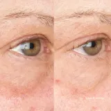 Perricone MD Hypoallergenic Clean Correction Eye Cream - Уход за кожей вокруг глаз: увлажняющий и осветляющий крем для глаз и век, уменьшающий темные круги, 15 мл — фото 6