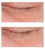 Perricone MD Cold Plasma Plus+ Eye Cream - Питательный крем для глаз против отеков и темных кругов, 15 мл — фото 6