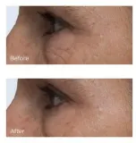 Perricone MD Cold Plasma Plus+ Eye Cream - Питательный крем для глаз против отеков и темных кругов, 15 мл — фото 7