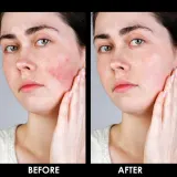Arval Couperoll Emergency Cream SPF20 - Крем, уменьшающий покраснения — фото 5