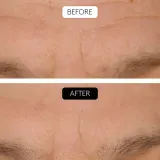 Cocunat Clinical Beauty Filler - Сыворотка против старения кожи с микроигловым уходом, 5 мл — фото 4