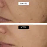 Cocunat Clinical Beauty Filler - Сыворотка против старения кожи с микроигловым уходом, 5 мл — фото 5