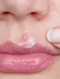 Точечные патчи от высыпаний breakout + aid Emergency Dots For Spots and Blemishes с маслом чайного дерева, 72 шт — фото 2