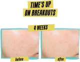 Kiehl's Dermatologist Solutions Expertly Clear Blemish-Treating & Preventing Lotion - Крем для лица для проблемной кожи, 60 мл — фото 4
