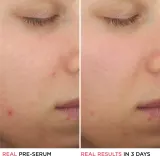 IT Cosmetics Bye Bye Breakout - в контексте того, что это сыворотка для лица: сыворотка для лица, уменьшающая избыток себума и признаки акне с салициловой кислотой, 30 мл — фото 6