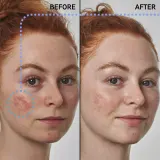 Сыворотка для лица The Inkey List Anti-Redness Solution with Azelaic Acid 10%, 30 мл — фото 1