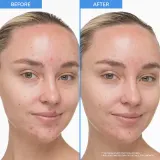 innisfree мягкая сыворотка с ретинолом и салициловой кислотой против несовершенств, 30 мл — фото 2
