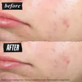 Kiehl's Since 1851 Truly Targeted Blemish-Clearing Solution невидимый жидкий патч для кожи с несовершенствами 15 мл — фото 2