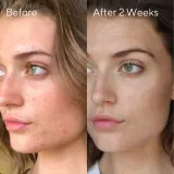 Murad InvisiScar Resurfacing Treatment средство для лица от следов постакне 15 мл — фото 3